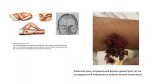 Лечение, диагностика и профилактика сапа