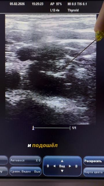 НОВЫЙ ЛАЙФХАК ПРИ ПОСТАНОВКЕ ЦВК #узинавигация #сосудистыйдоступ#ЦВК