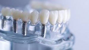 Стоматология на кухне: опасные товары для лечения зубов заполонили маркетплейсы