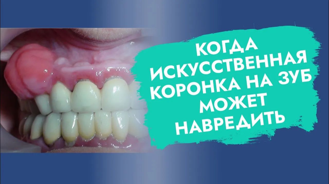 Зубные коронки. Вред или польза? Чего больше?