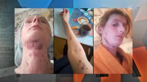 "Кожа нежная": герой шоу "Мужское/Женское" объяснил происхождение синяков на лице экс-жены