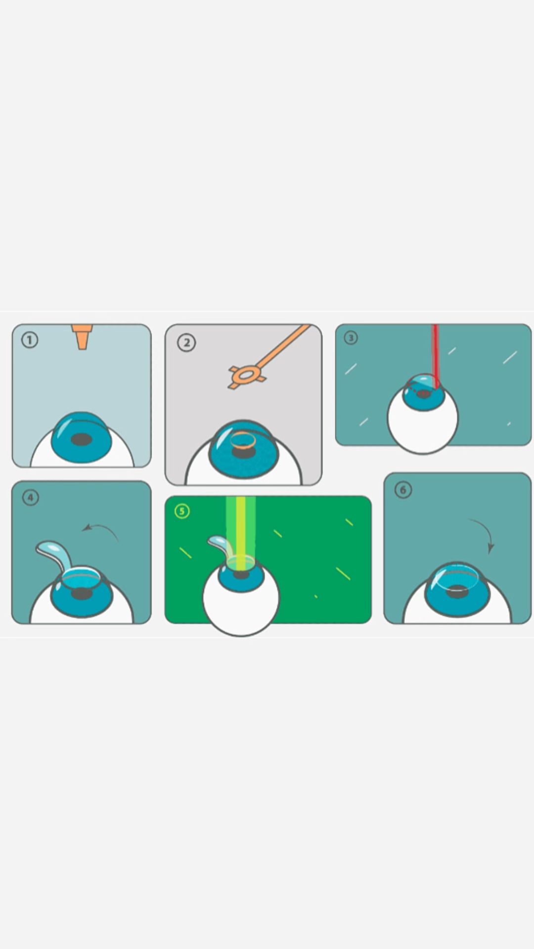 Главные преимущества метода Фемто-ЛАСИК смотреть онлайн