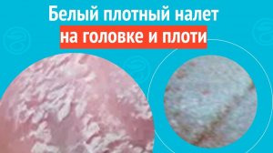 😕 Белый плотный налет на головке и плоти. Клинический случай № 1736
