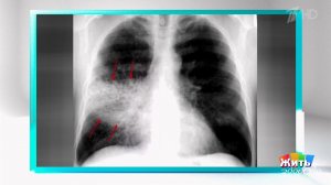 Пневмония: красный уровень. Жить здорово! Фрагмент выпуска от 06.02.2026