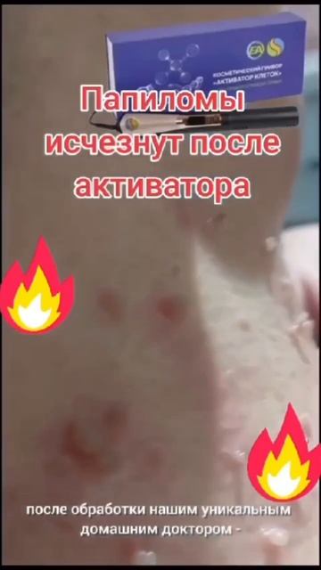 Активатор  убирает папилломы!