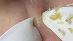 Выдавливание прыщей, угрей, черных точек и камедонов #120