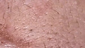 Выдавливание прыщей, угрей, черных точек и камедонов #119