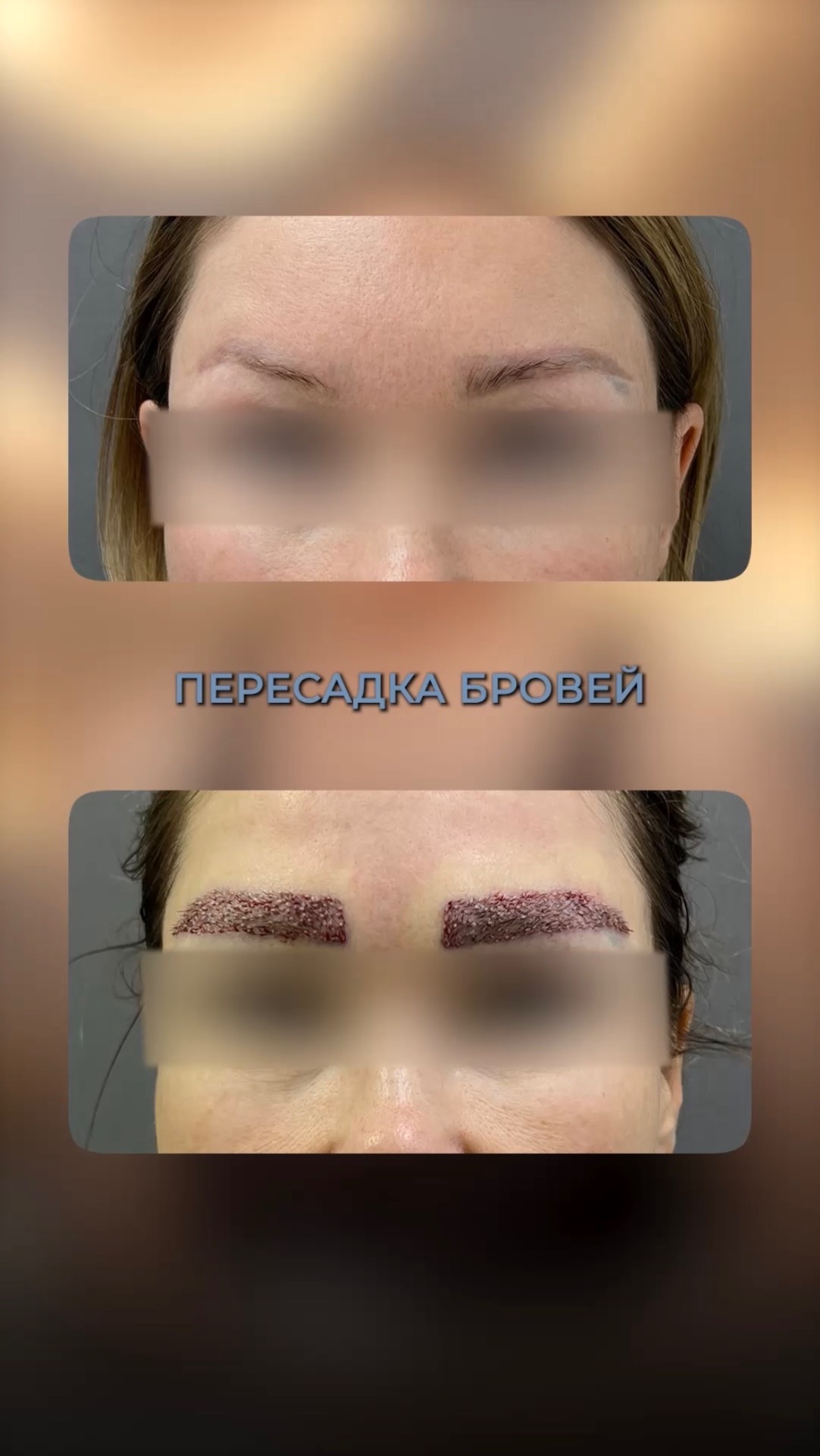 Пересадка бровей – ЗА или ПРОТИВ? смотреть онлайн