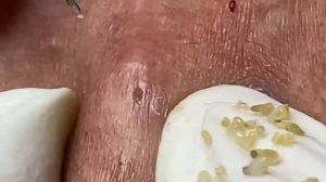 Выдавливание прыщей, угрей, черных точек и камедонов #127