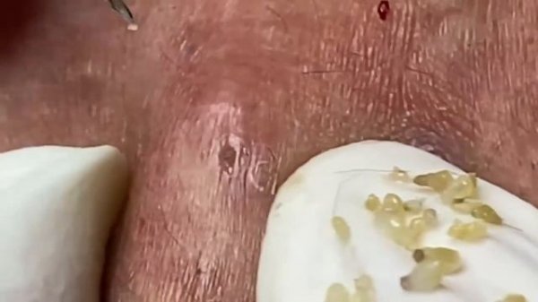 Выдавливание прыщей, угрей, черных точек и камедонов #127