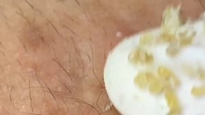 Выдавливание прыщей, угрей, черных точек и камедонов #130