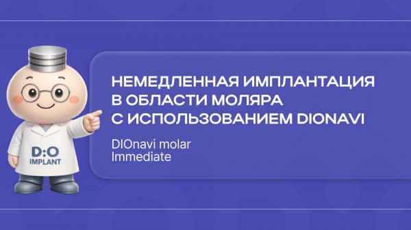 Немедленная имплантация в области моляра с использованием DIOnavi