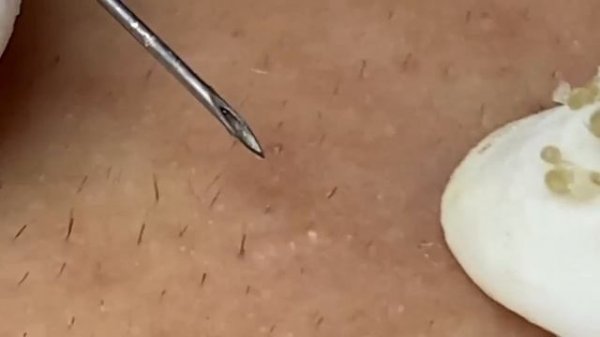 Выдавливание прыщей, угрей, черных точек и камедонов #128