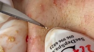 Выдавливание прыщей, угрей, черных точек и камедонов #131