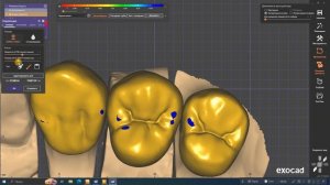 Последовательная дизокклюзия на маленьком кейсе