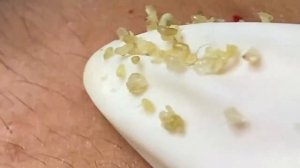 Выдавливание прыщей, угрей, черных точек и камедонов #133