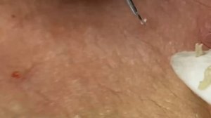 Выдавливание прыщей, угрей, черных точек и камедонов #138