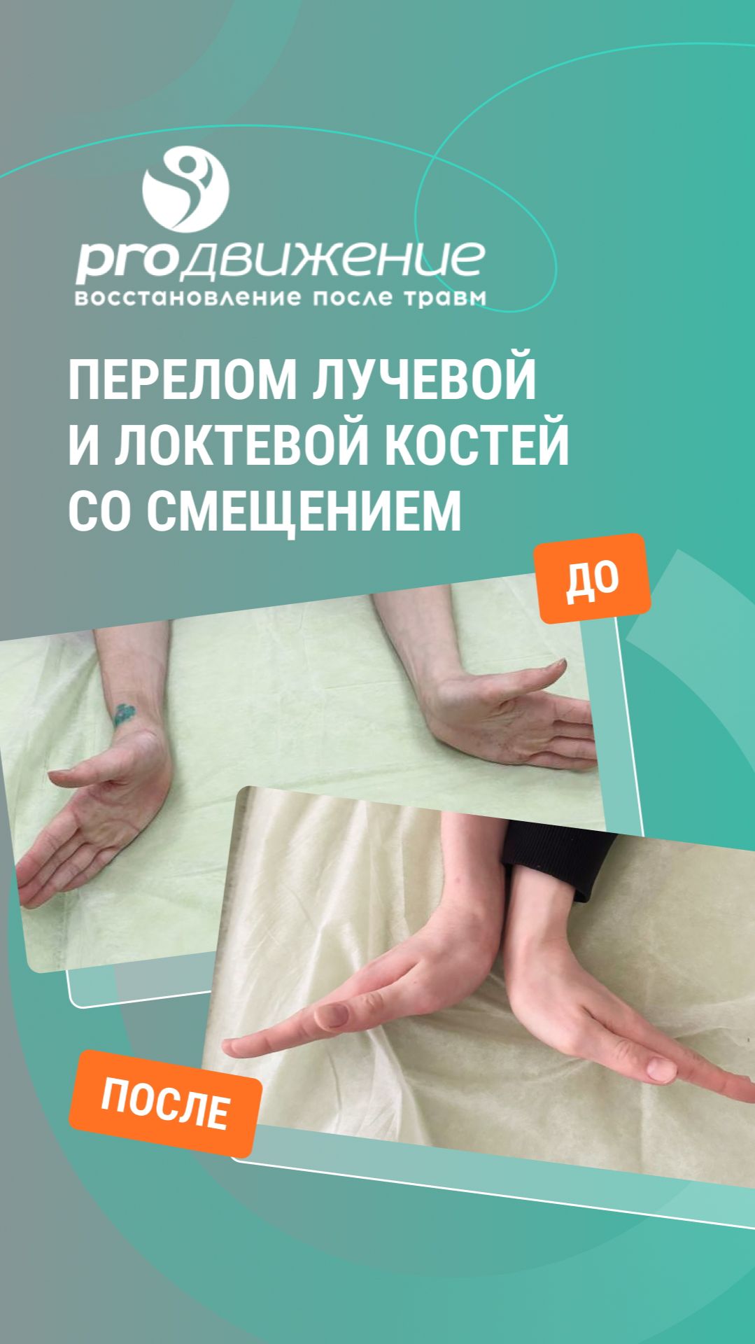 ✅ Перелом лучевой и локтевой костей со смещением. Комплексная реабилитация