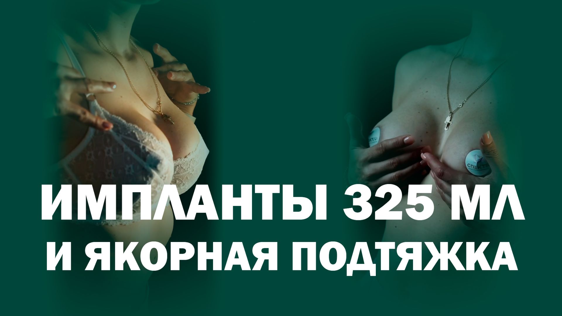 Подтяжка и увеличение груди: динамика формирования формы и рубцов