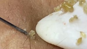 Выдавливание прыщей, угрей, черных точек и камедонов #136