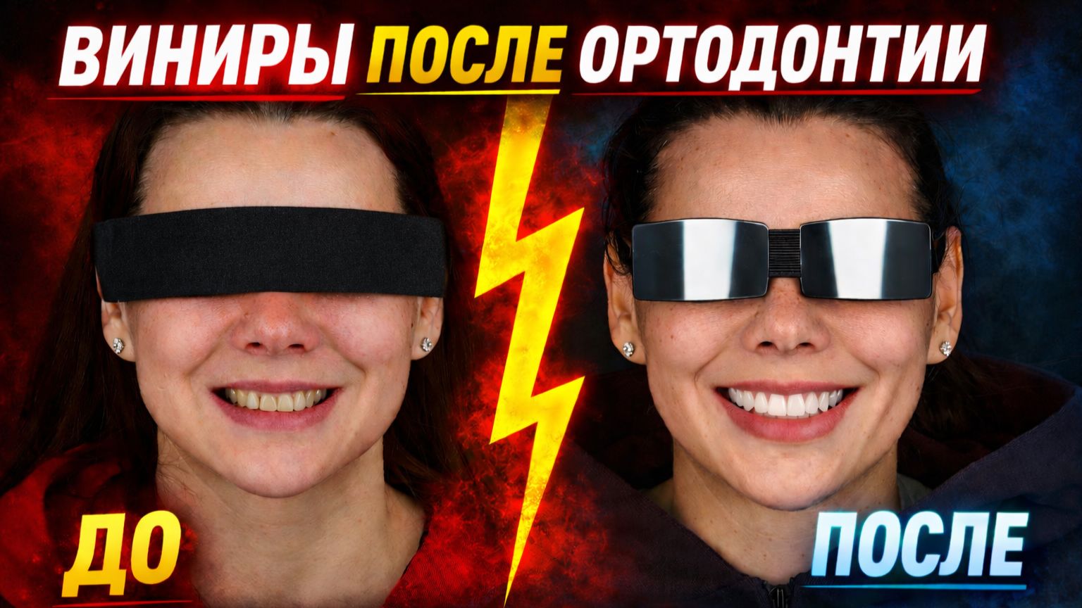 Виниры после ортодонтии: полный клинический разбор (Bleach3) смотреть онлайн