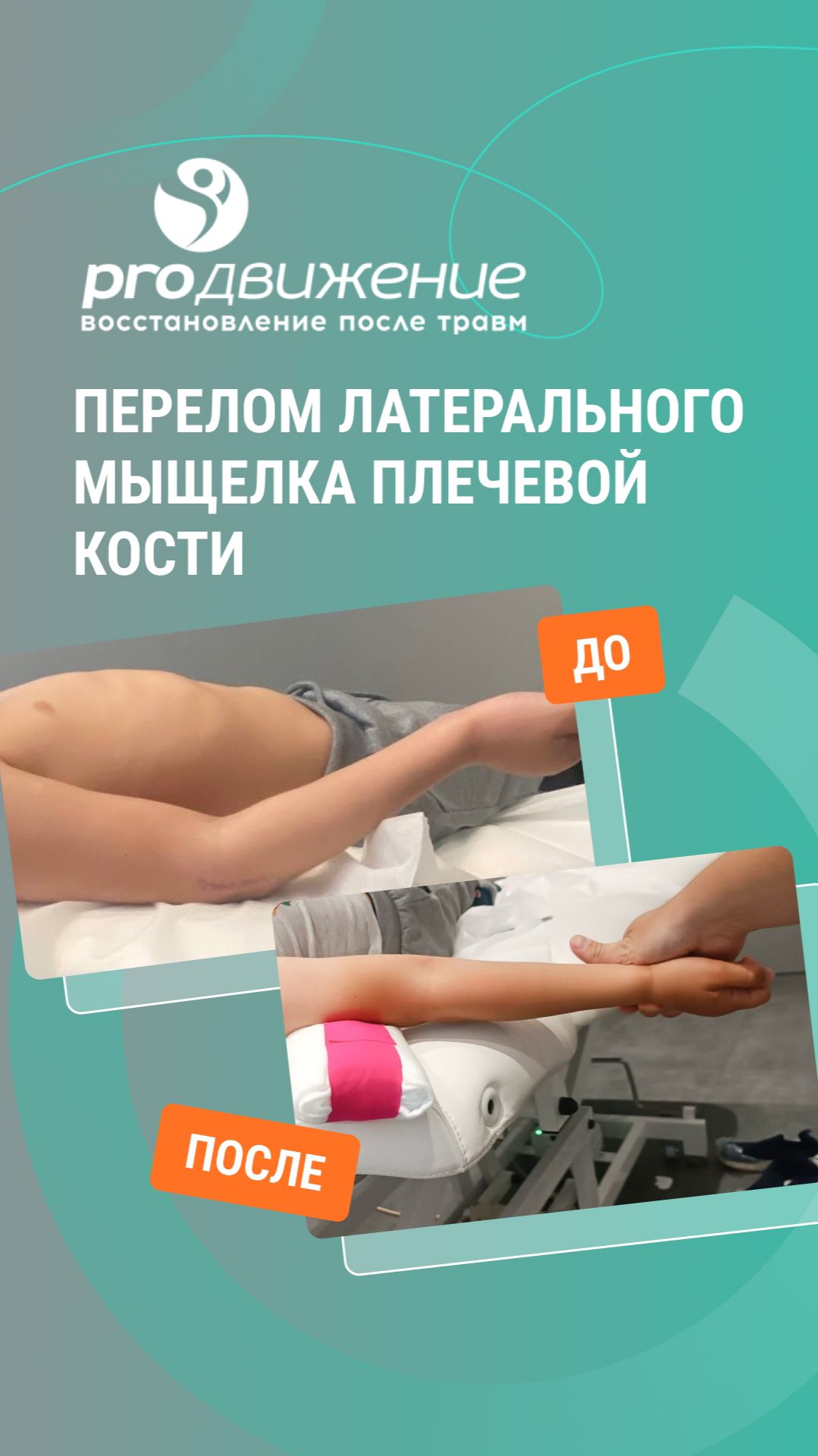 🔹 Перелом латерального мыщелка плечевой кости. Комплексная реабилитация