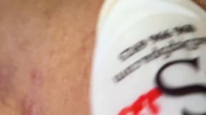 Выдавливание прыщей, угрей, черных точек и камедонов #143