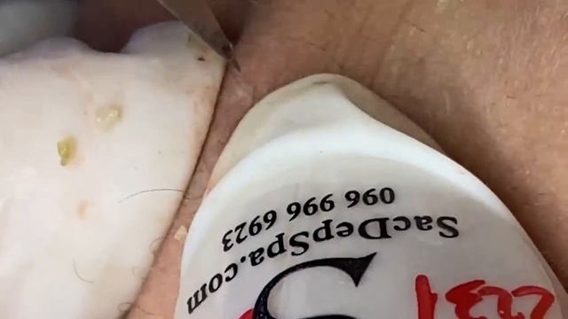 Выдавливание прыщей, угрей, черных точек и камедонов #142 смотреть онлайн