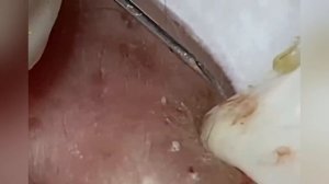 Выдавливание прыщей, угрей, черных точек и камедонов #149