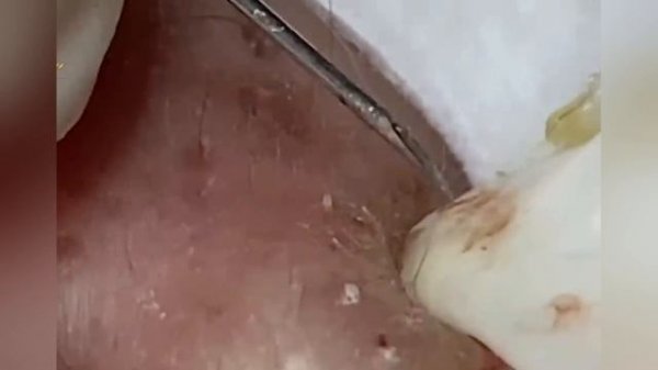 Выдавливание прыщей, угрей, черных точек и камедонов #149