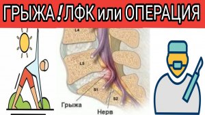 Грыжа межпозвонковая в поясничном отделе! Операция или лечебная физкультура?