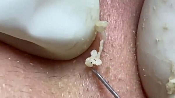 Выдавливание прыщей, угрей, черных точек и камедонов #151