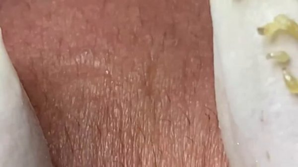 Выдавливание прыщей, угрей, черных точек и камедонов #147