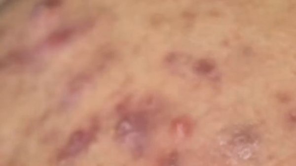 Выдавливание прыщей, угрей, черных точек и камедонов #154