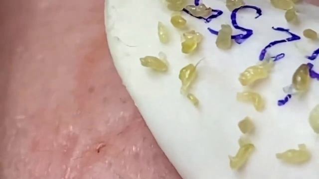 Выдавливание прыщей, угрей, черных точек и камедонов #157