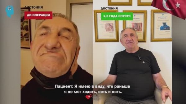 🇹🇷✨ Дистония: 20 лет борьбы и новый этап благодаря DBS