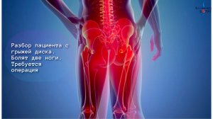 Разбор пациента с грыжей диска. Болят две ноги. Требуется операция