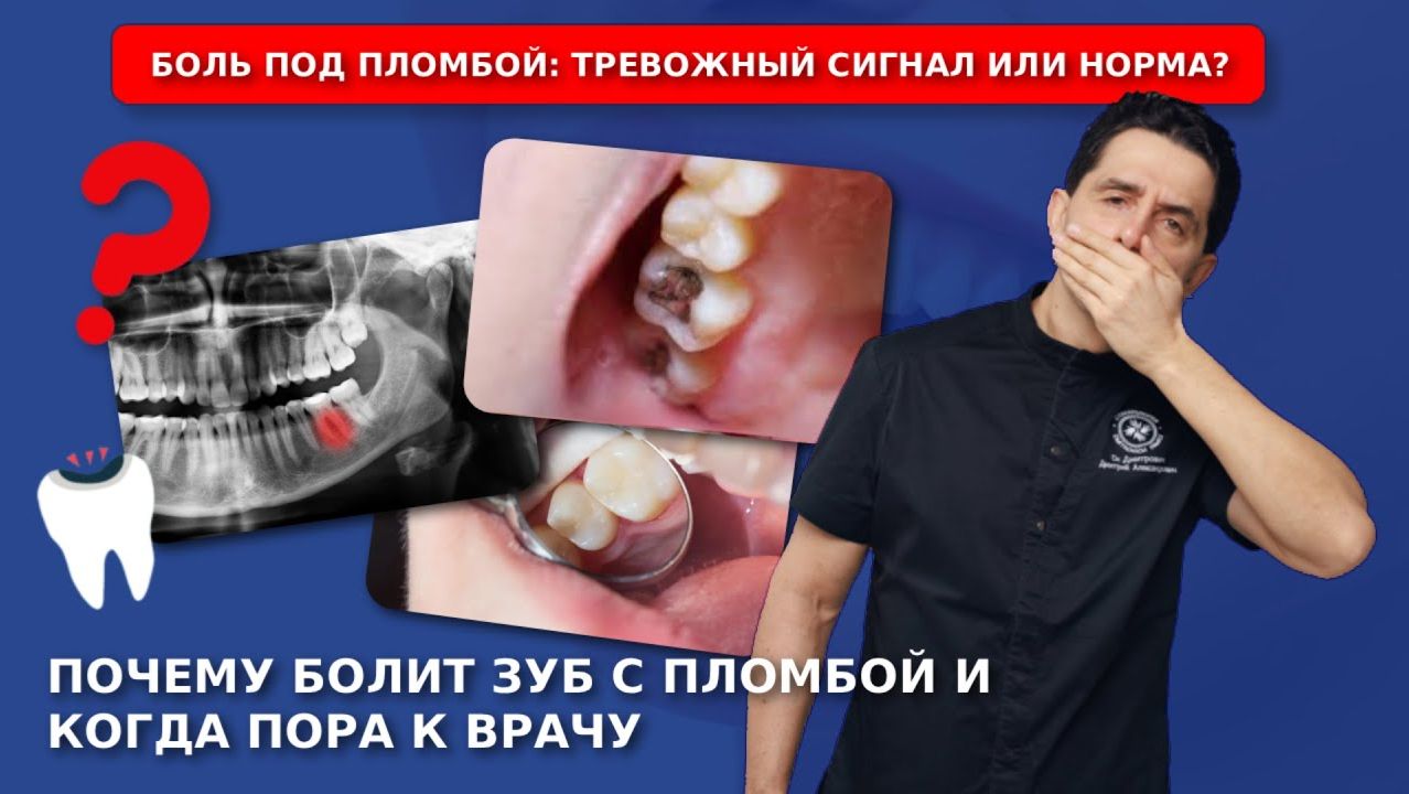 Почему болит зуб под пломбой? Разбираемся. смотреть онлайн