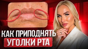 Как приподнять уголки рта при помощи филлера. Разбор техники