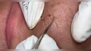 Выдавливание прыщей, угрей, черных точек и камедонов #155