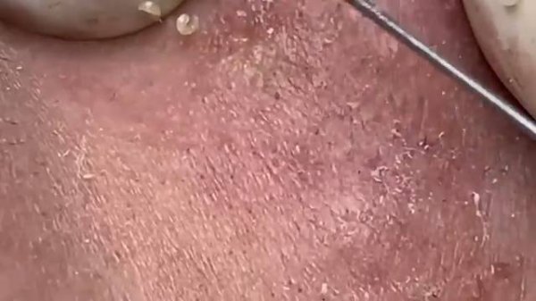 Выдавливание прыщей, угрей, черных точек и камедонов #152