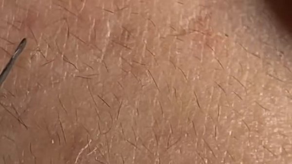 Выдавливание прыщей, угрей, черных точек и камедонов #160