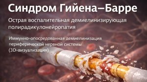 Синдром Гийена–Барре (ГБС)