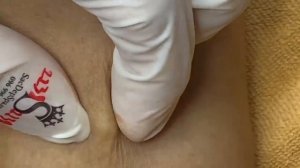 Выдавливание прыщей, угрей, черных точек и камедонов #161