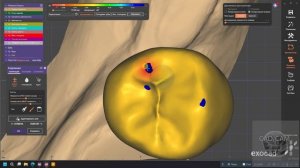 Тотал по Славичеку на обе челюсти