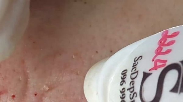 Выдавливание прыщей, угрей, черных точек и камедонов #163