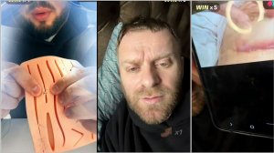 Показал Шов, Плохо Заживает, Коля Продемонстрировал Свои Навыки в Шитье, Улетел в Блок