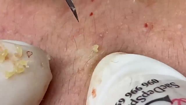 Выдавливание прыщей, угрей, черных точек и камедонов #165 смотреть онлайн