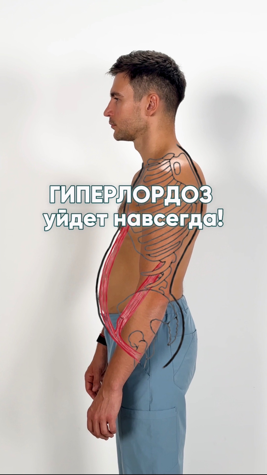 Гиперлордоз уйдет НАВСЕГДА после ЭТИХ упражнений! #здоровье #гиперлордоз #упражнения