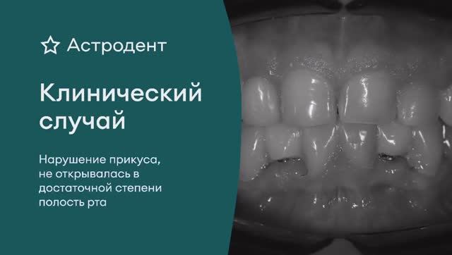 КЕЙС: нарушение прикуса, ортодонтическое лечение в Астродент